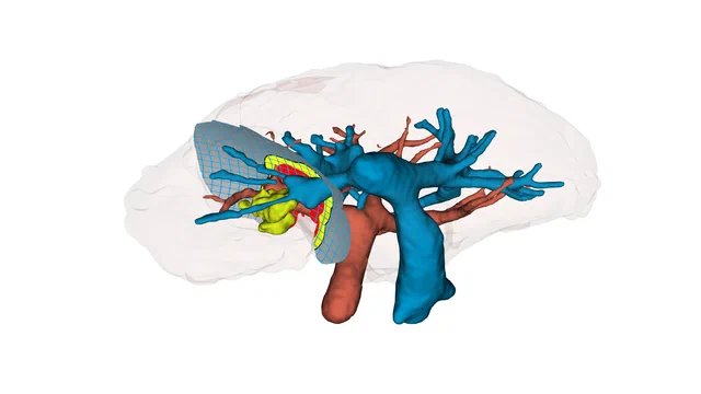 A segmented liver with its portal and hepatic vessel trees and two tumours, rendered in 3D Slicer
