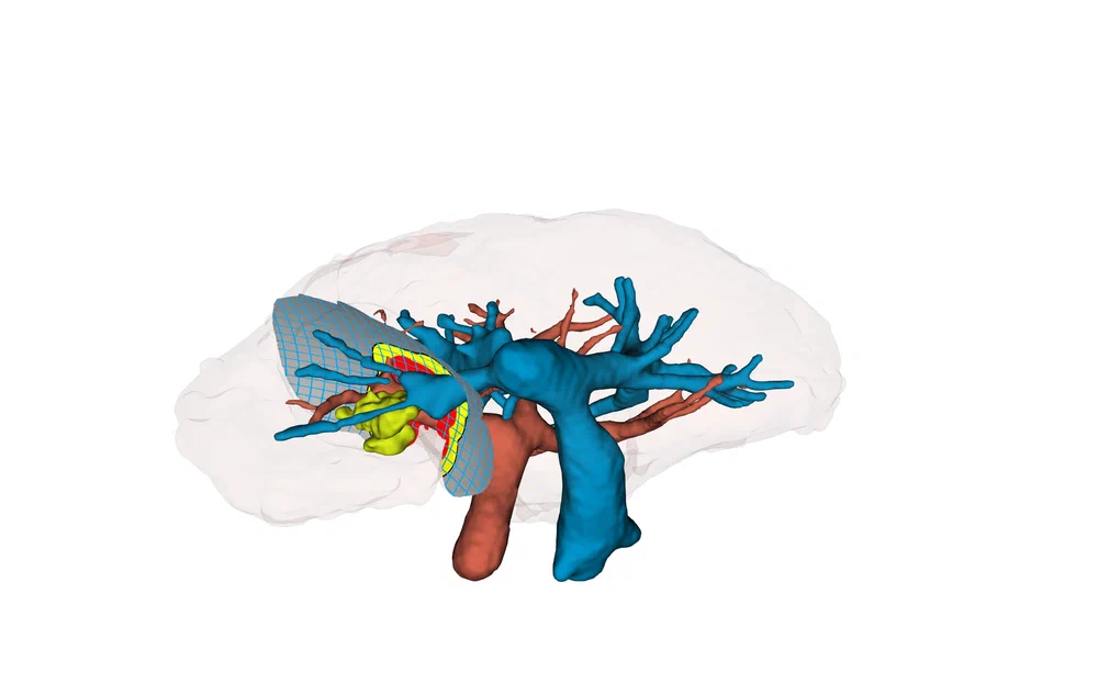 A segmented liver with its portal and hepatic vessel trees and two tumours, rendered in 3D Slicer